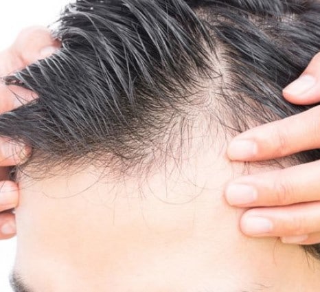 Se trata de un nuevo tratamiento para alopecia androgénica masculina y femenina que consiste en aplicar localmente en el cuero cabelludo un fármaco antiandrógeno que permite el engrosamiento del pelo y retrasa su caida.